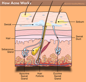 How Acne Works HowStuffWorks