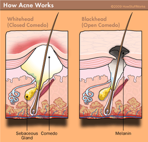 How Acne Works HowStuffWorks