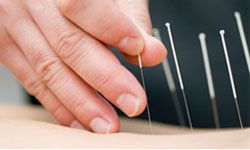 Acupuncture is one of the more common complementary therapies used in hospitals.