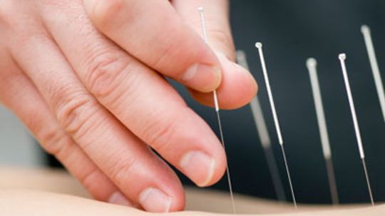 Can acupuncture and hypnosis treat infertility?