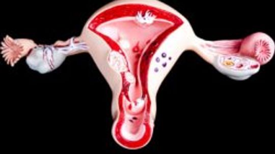 Endometriosis Questions and Answers