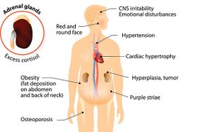 Some of the symptoms of Cushing's syndrome include a round red face, high blood pressure (hypertension) and obesity.