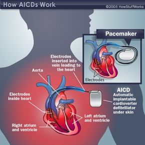 Diagram of an automatic implantantable cardioverter defibrillator