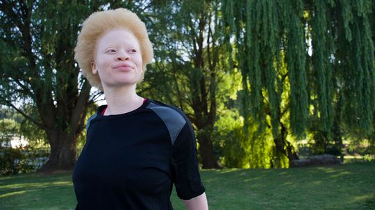 How Albinism Works