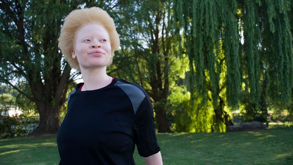 albinism