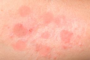 bumpy red skin rash 