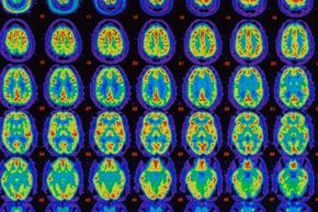 PET scans of brains