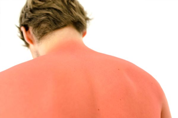 Man's back with sunburn