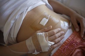 A woman recovering from laparoscopic appendicitis surgery.