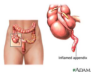 Adenomas grow and compress the appendix causing it to become inflamed (appendicitis). An inflamed appendix is in danger of rupturing.