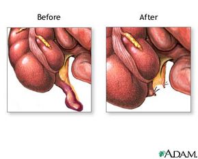 Before and after surgery.