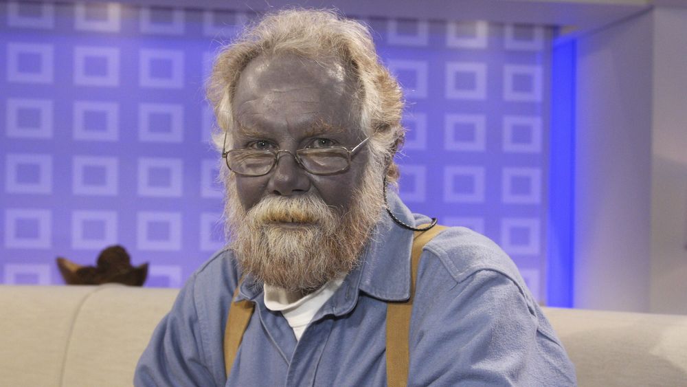 Argyria“border=