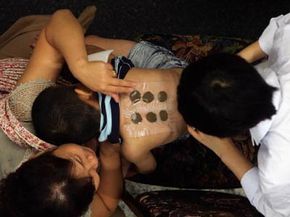 A doctor applies herbal medicine to a patient's back at a traditional Chinese medicine clinic in Beijing. 