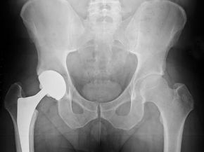 Your X-ray after a hip replacement might look a little something like this.