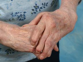 hands with rheumatoid arthritis