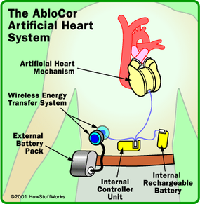 artificial heart diagram