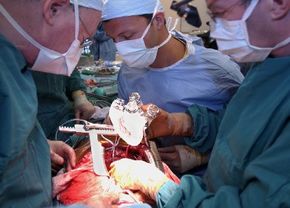 Surgeons implanting the AbioCor heart