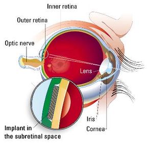 Here you can see where the ASR is placed between the outer and inner retinal layers.