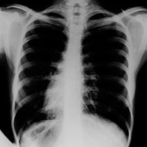 Traditional X-ray machines give a rough look at your body's density. Newfangled backscatter scanners show more exterior detail, making them useful for security purposes.