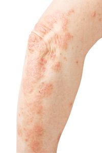 Bacteria that touch your skin are more likely to infect you if your skin is broken. See more pictures of skin problems.