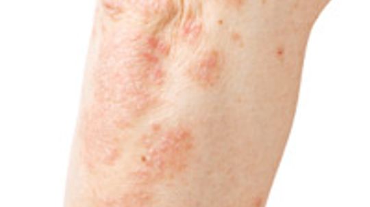 Bacterial Skin Infections