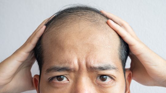 Baldness: Types and Treatments
