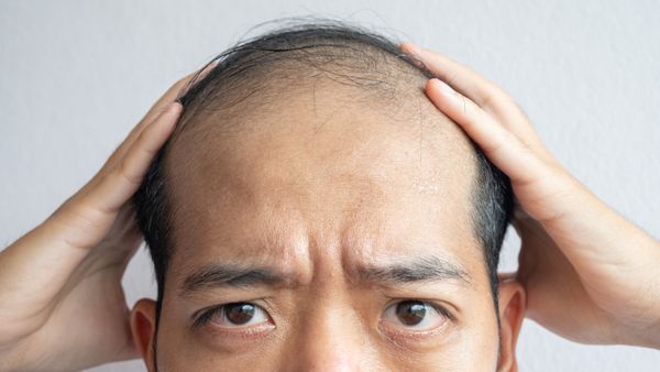 A man worried about his hair loss and baldness problem