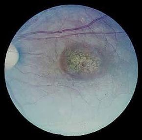 ­A magnified image of an eye with age-related macular degeneration