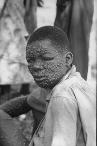 A victim of smallpox