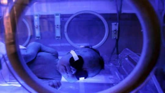 Why Are Some Babies Treated With Bili Lights?