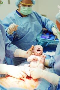 A C-section is sometimes the only option to safeguard both the mother's and the baby's health.