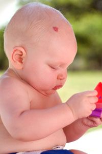 The two major types of birthmarks are red and pigmented. 