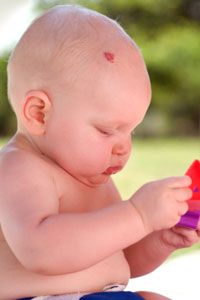 baby with birthmark