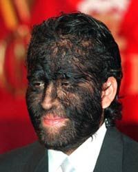 Fajardo Aceves Jesus Manuel, from Mexico, has congenital hypertrichosis.