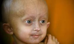 a young girl with progeria