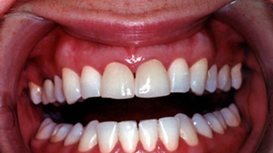 Why do I have black gums?