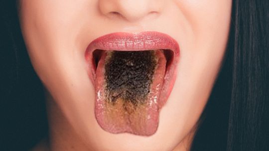 Black Hairy Tongue: It's Gross, but You'll Live