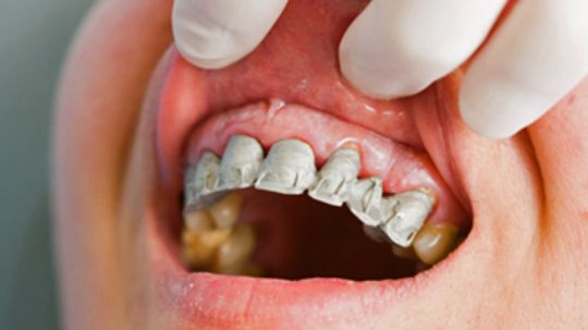 Why do my gums bleed when I brush my teeth?