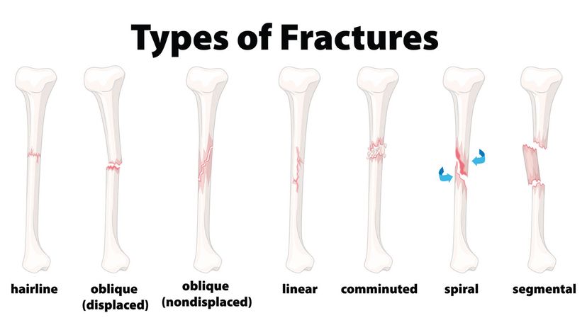 types of fractures