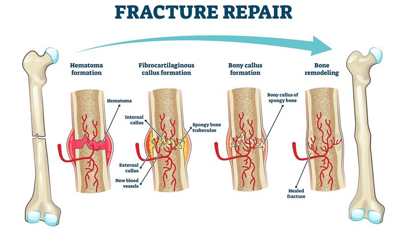 Fracture repair