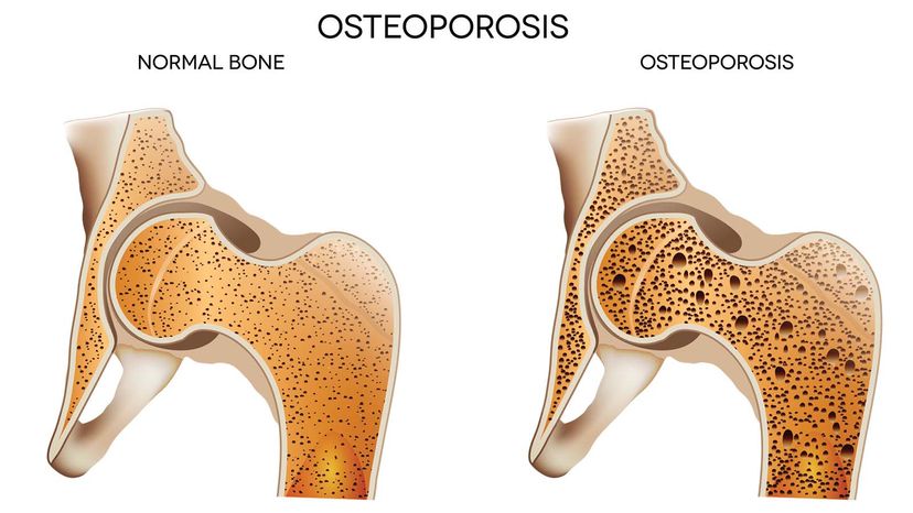 Osteoporosis