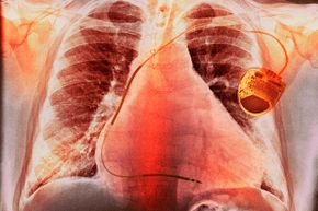 2015年的一项研究表明，外科医生可以通过在病人心脏搭桥手术后，向患者心脏周围的脂肪中注射肉毒杆菌来减少不规则心律(AFib)的机会。＂border=