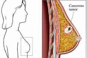 A medical illustration shows a cancerous tumor within the female breast.