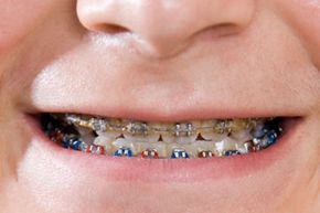 Braces aren't a one-size -- or even a one-style -- fits all endeavor.