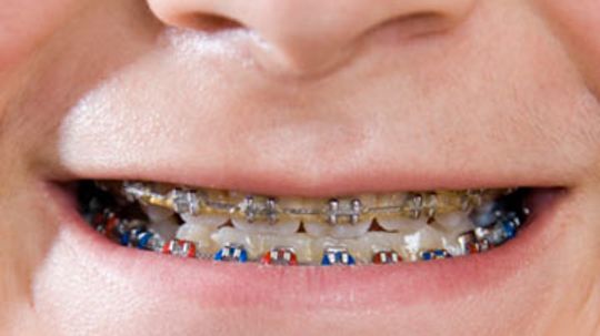 What colors and styles do braces come in?