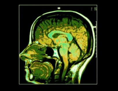 MRI cross section image of human head