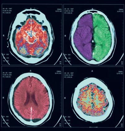 CT scanned images of the human brain