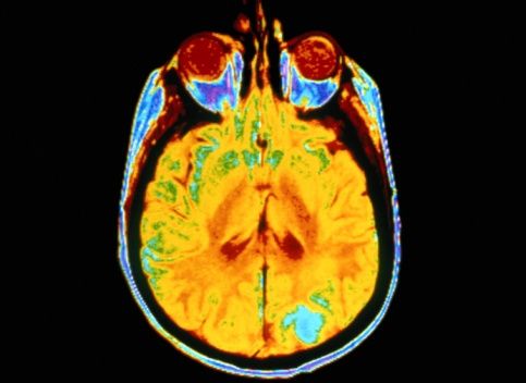 Brain scan showing brain cancer