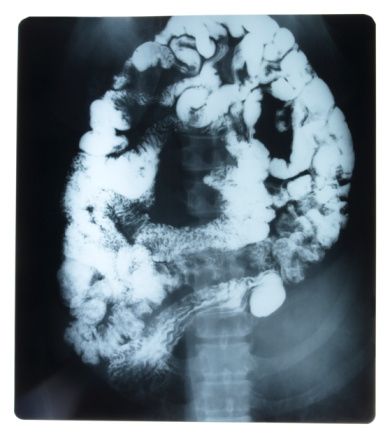 Cat scan of brain