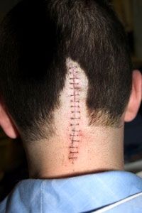 scar from brain surgery
